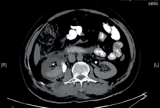 Axial image showing pelviureteric injury with contrast in the peripelvic region