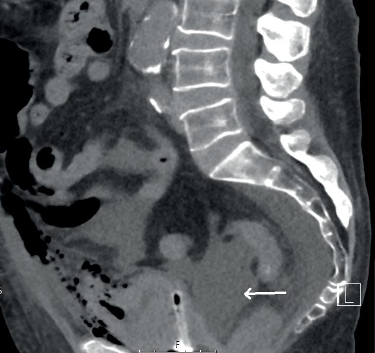 CT showing intraperitoneal bladder injury after transurethral resection of bladder tumour
