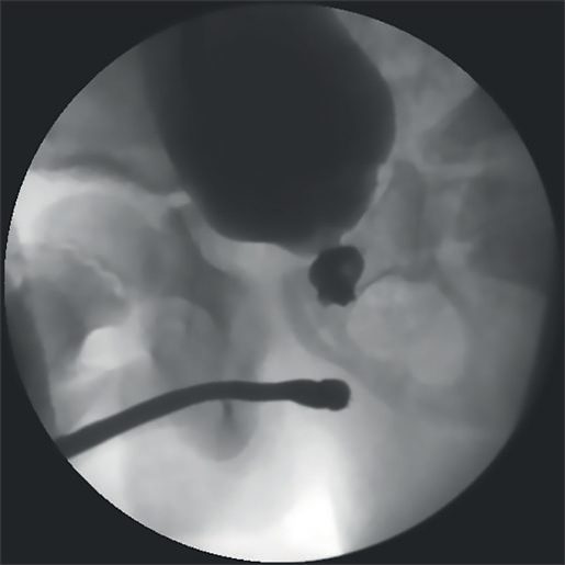 Retrograde urethrogram and voiding cystourethrogram in pelvic fracture urethral injury, showing the gap