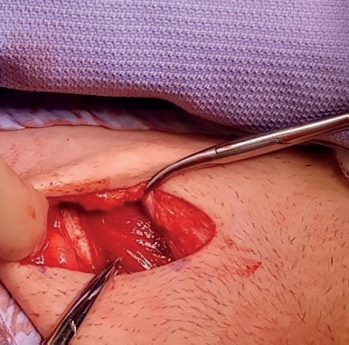 Adult undescended testis: the undescended inguinal testis is mobilised and retained in a pouch constructed between the dartos muscle and skin
