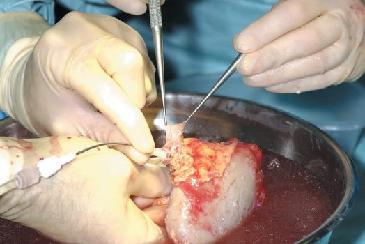 After removal from the donor, the kidney is flushed with chilled organ preservation solution