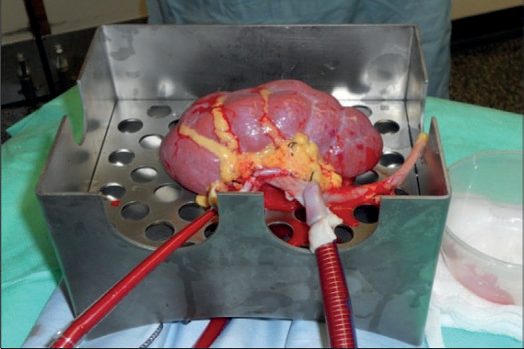 Donor kidney undergoing normothermic machine perfusion