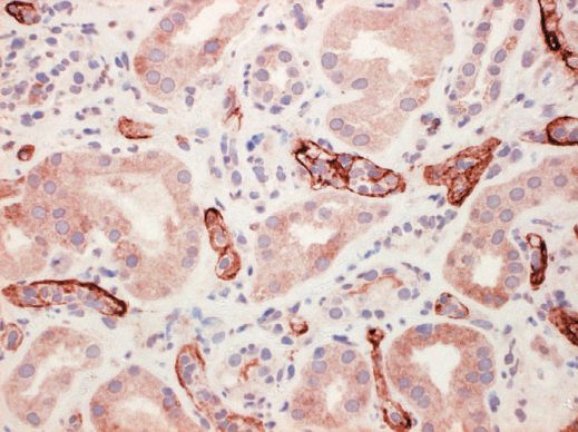Acute antibody-mediated renal allograft rejection, with widespread staining for complement