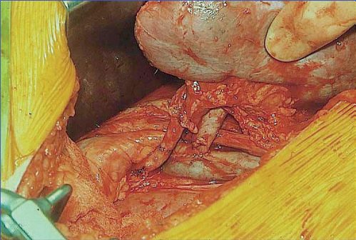 Renal allograft implantation techniques