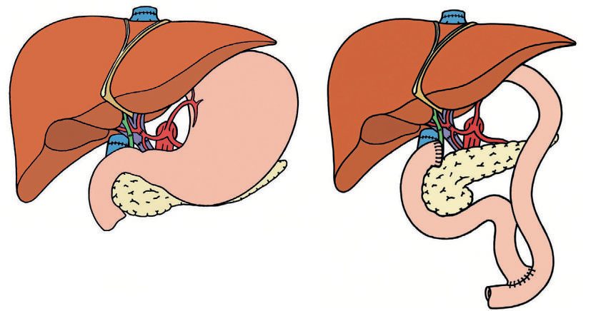 The standard deceased donor liver transplant with a classical caval anastomosis
