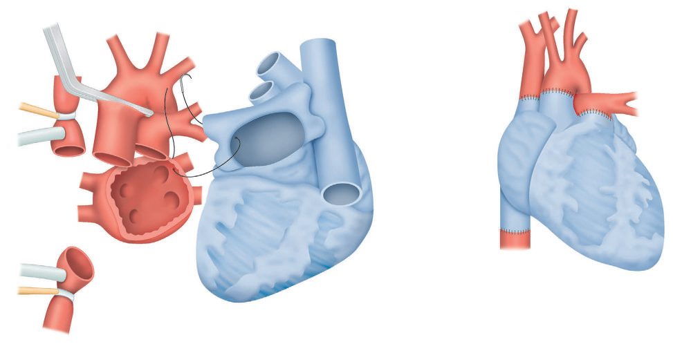 Cardiac transplantation: a left atrial cuff is fashioned, into which the four pulmonary veins drain