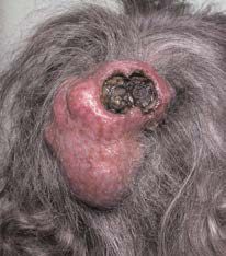 Cock's peculiar tumour: a mass of granulation tissue protruding from the base of a previously infected and ruptured sebaceous cyst