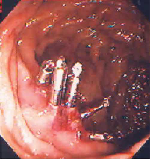 Endoscopic image of multiple clips placed to provide haemostasis