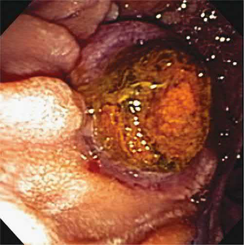 An impacted common bile duct stone seen extruding through the ampulla, best treated by needle-knife sphincterotomy to release the stone