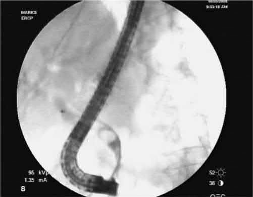 ERCP image of a stone in the distal common bile duct