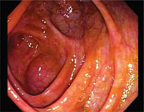 The caecum seen at colonoscopy, identified by the ileocaecal valve, the appendiceal orifice, and the classic caecal strap - the landmarks confirming complete caecal intubation