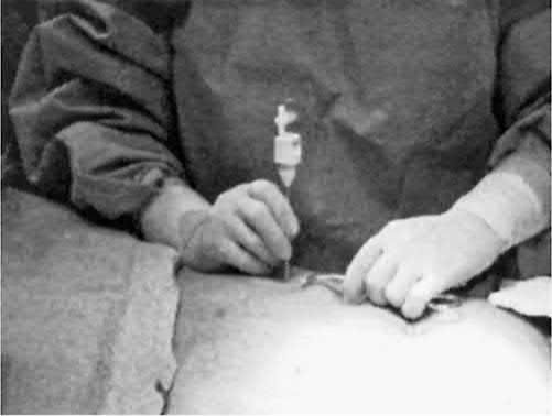 Proper Veress technique in the left upper quadrant using the dominant hand with the wrist stabilized on the patient; the nondominant hand stabilizes the abdominal wall