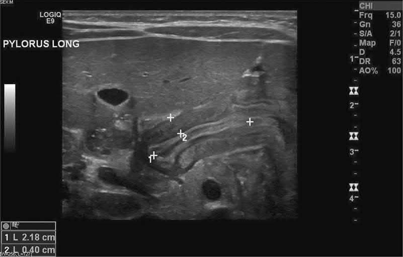 Pyloric channel visualised by ultrasound showing an elongated, thickened pylorus. Pyloric length greater than 14 mm and thickness greater than 3 mm are diagnostic