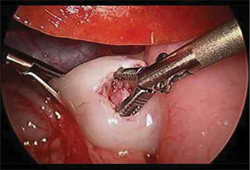 Laparoscopic pyloromyotomy showing spreading of the muscle fibres using blunt graspers; the myotomy is adequate when mucosa bulges through and the two muscle edges move freely
