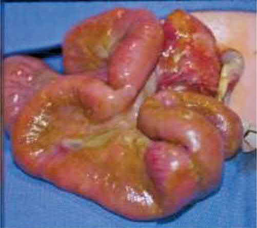 Gastroschisis with eviscerated bowel that appears matted together