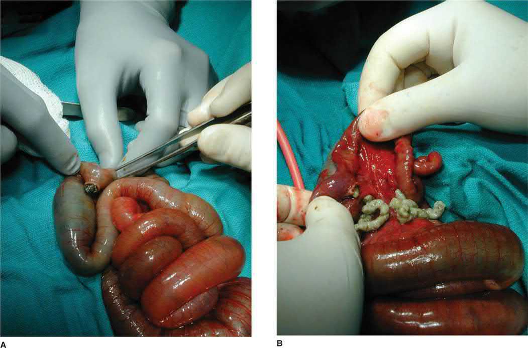 Meconium ileus: removal of the meconium ball and evacuation of inspissated meconium