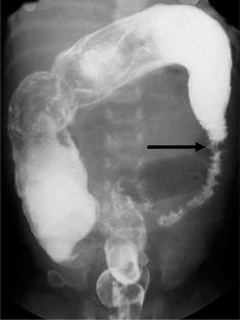 Contrast enema showing dilated proximal colon with narrowed distal segment, seen in Hirschsprung disease. Black arrow points to likely transition zone