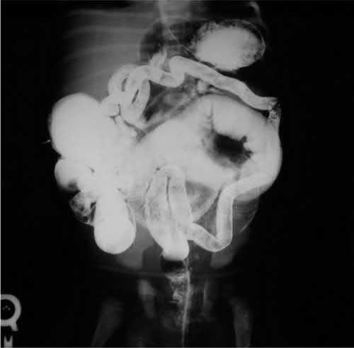 Total colonic Hirschsprung disease