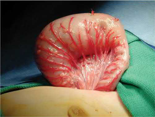 Hirschsprung disease transition zone. Antimesenteric stitches from intraoperative full-thickness biopsies of colon wall