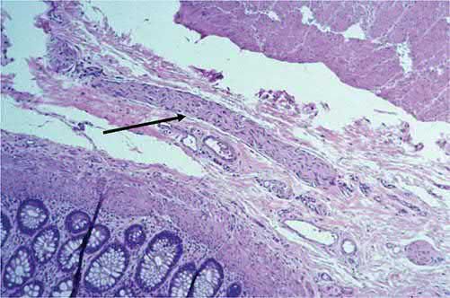 Histological slide of a suction rectal biopsy in Hirschsprung disease, characterised by lack of ganglion cells and elevated acetylcholinesterase staining; black arrow points to a hypertrophied nerve