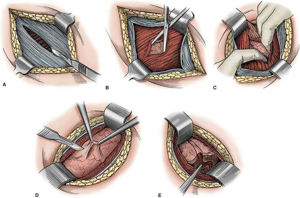 McBurney muscle-splitting incision. A. Division of the external oblique aponeurosis. B. The internal oblique and transversus muscles are split. C. The index fingers enlarge the opening. D. Incision of the peritoneum. E. Exposure of the appendix
