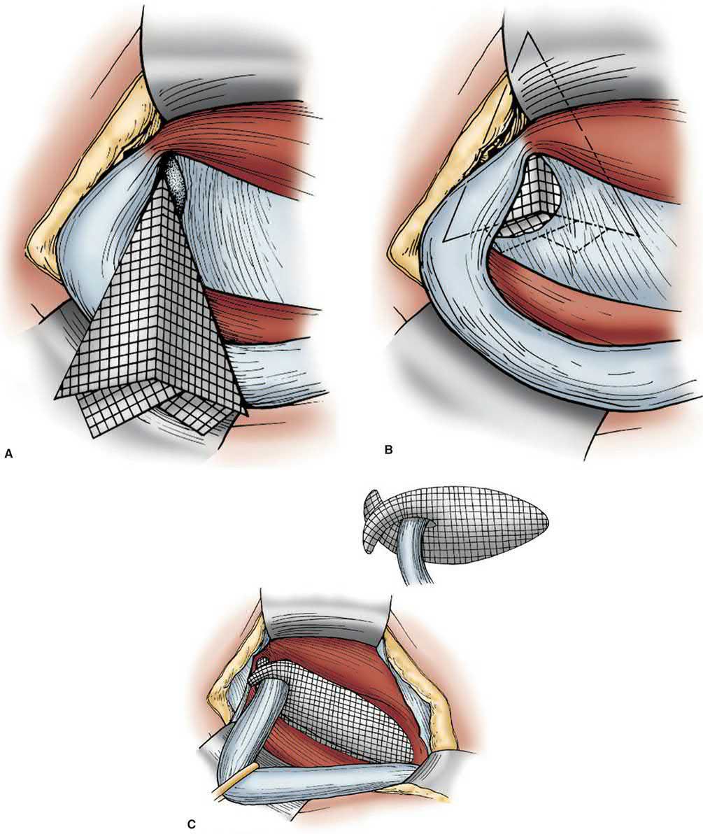 The sutureless 'patch and plug' tension-free inguinal hernia repair: mesh plug passed through the internal ring, opened behind the transversalis fascia, and an onlay patch on the posterior wall