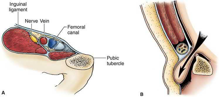 The anatomy of the femoral hernia: structures posterior to the inguinal ligament (A) and the sac passing through the femoral canal to bulge in the groin below the inguinal ligament (B)