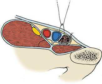 The Lichtenstein polypropylene plug for repair of a femoral hernia, sutured into the femoral canal