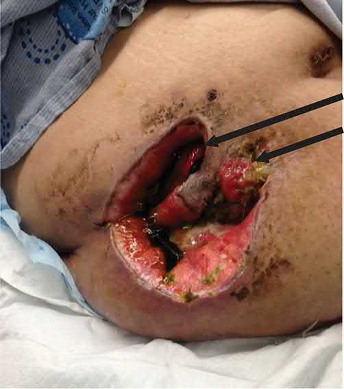 Small bowel enterocutaneous fistula adjacent to an ileostomy, with significant skin and subcutaneous tissue damage