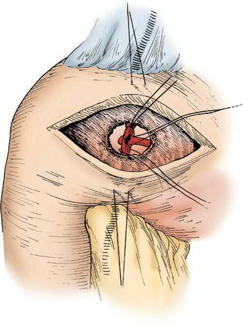 Suture control of a bleeding duodenal ulcer: a longitudinal pyloric incision is made and figure-of-eight sutures placed above and below the ulcer to occlude the gastroduodenal artery