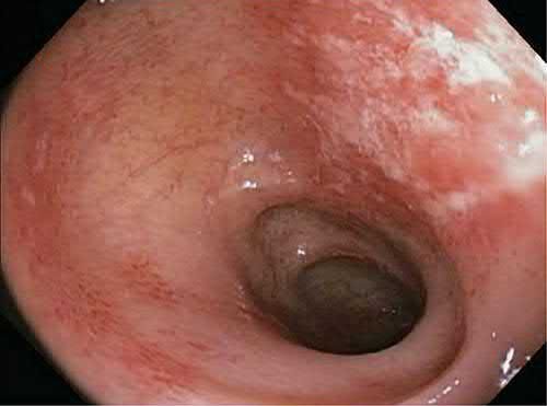 Ischaemic colitis at colonoscopy