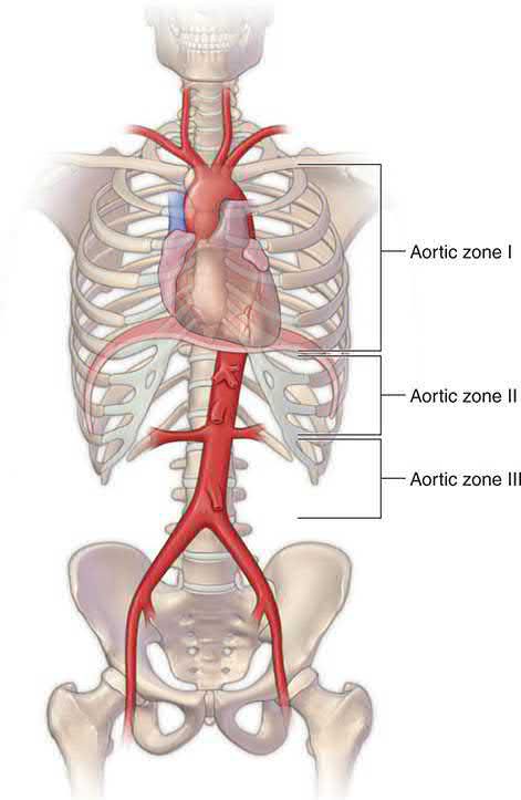 Aortic zones for positioning a REBOA device: Zone I between the subclavian and coeliac arteries, Zone II between the coeliac artery and the lowest renal artery, Zone III below