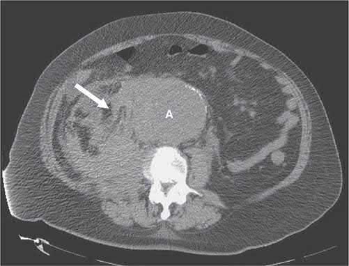 CT scan of a ruptured abdominal aortic aneurysm with retroperitoneal haematoma (arrow)