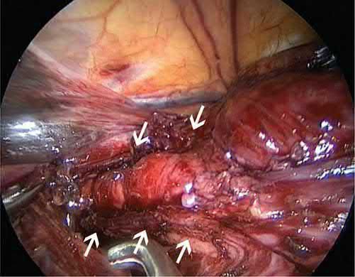 Completed laparoscopic Heller myotomy prior to fundoplication; arrows point to the divided esophageal and gastric muscle with bulging mucosa between them