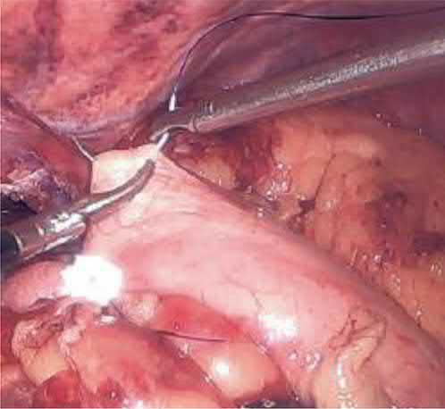 Construction of the Nissen fundoplication