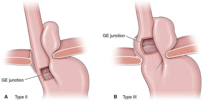 Types II and III paraesophageal hernia