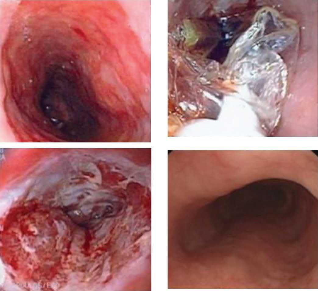 Steps in radiofrequency ablation of Barrett oesophagus