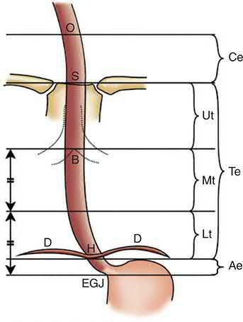 Description of the different levels of oesophageal tumour, from the cervical oesophagus to the abdominal oesophagus