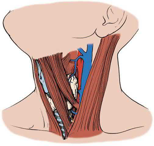 Anatomical structures of the left neck below the platysma, with the incision line marked