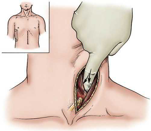 Left cervical incision with the sternocleidomastoid reflected laterally