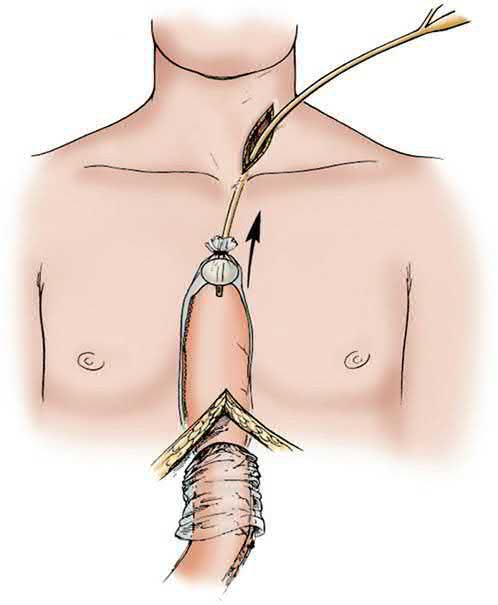 The gastric conduit is atraumatically pulled through the posterior mediastinum into the cervical wound