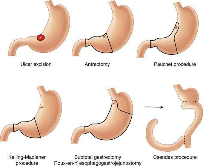 Operations for gastric ulcer, showing the resection lines used for ulcers at different sites within the stomach