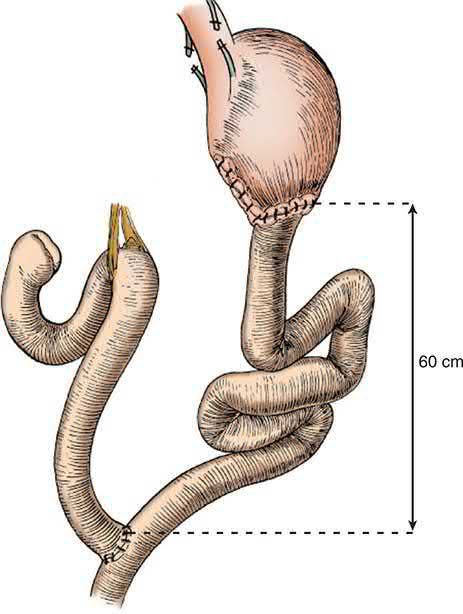 Roux-en-Y gastrojejunostomy used to treat alkaline reflux gastritis