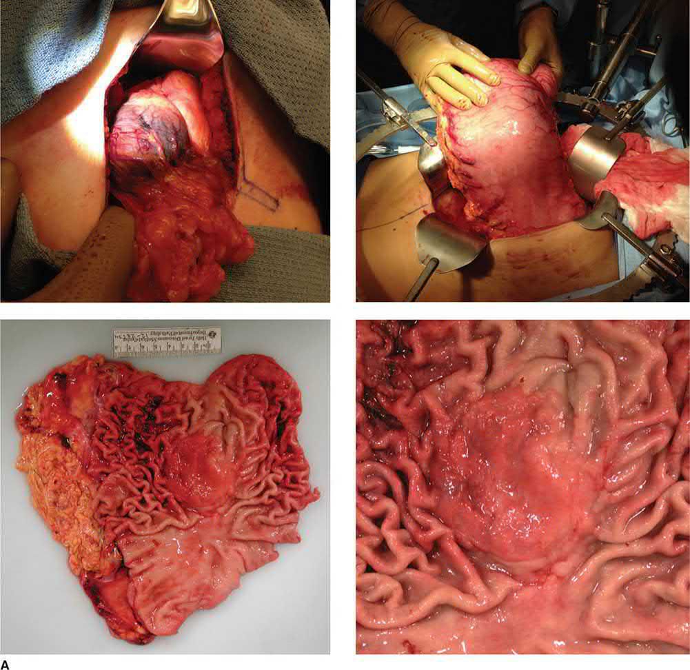 Subtotal gastrectomy with D2 lymphadenectomy for gastric adenocarcinoma, with pathology demonstrating pT4a, pN3b and 24/44 lymph nodes positive