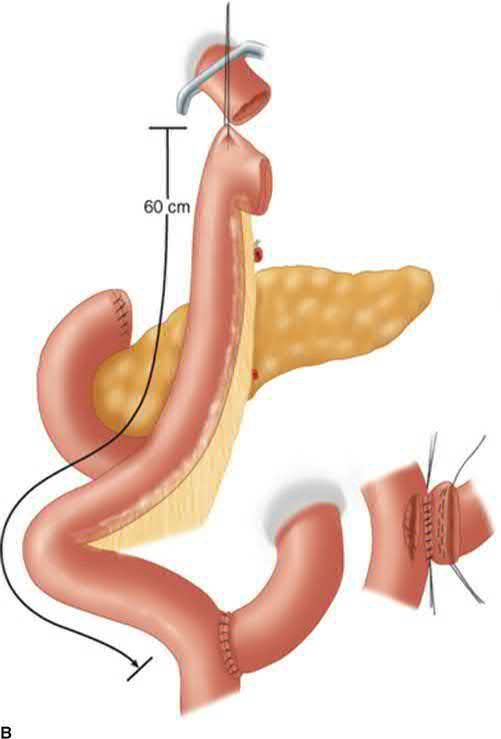 Roux-en-Y reconstruction after total gastrectomy
