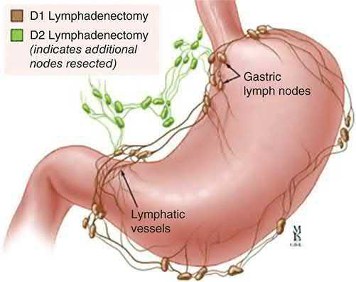 D1 versus D2 lymphadenectomy: D1 resects the perigastric nodes (brown), while D2 is an extended resection of the nodes surrounding the coeliac artery (green)