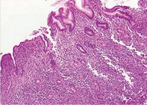 Haematoxylin and eosin stain of a gastric diffuse large B-cell lymphoma