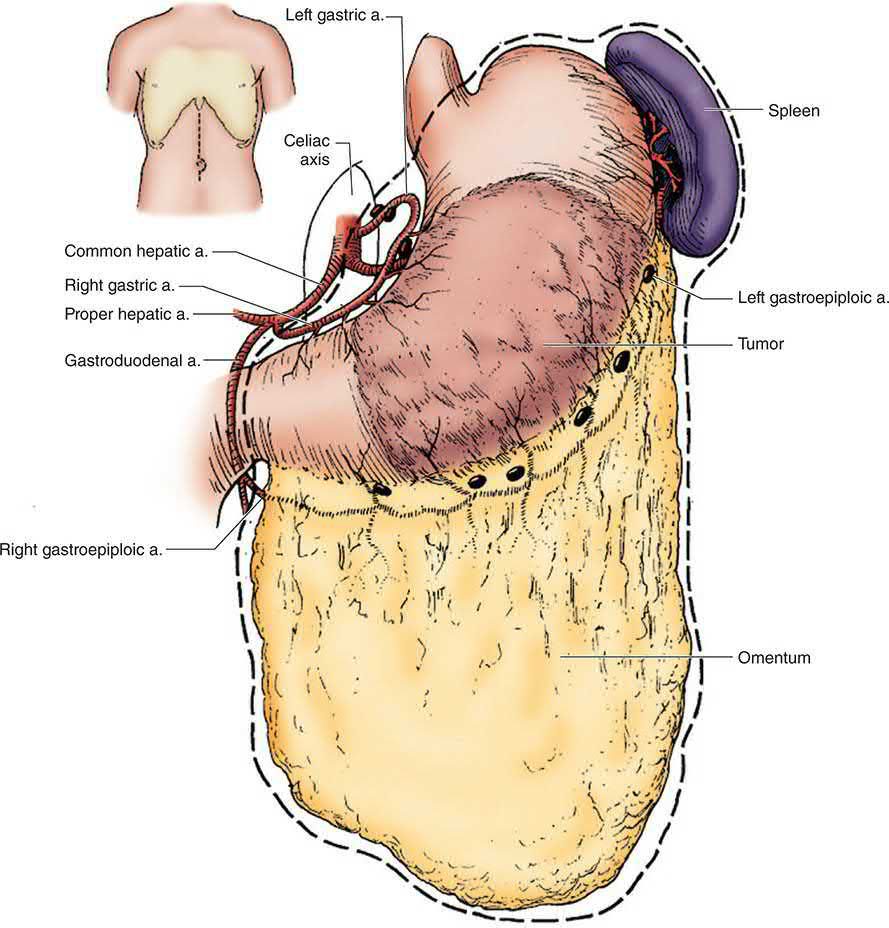 Anatomy relevant to resections for gastric carcinoma