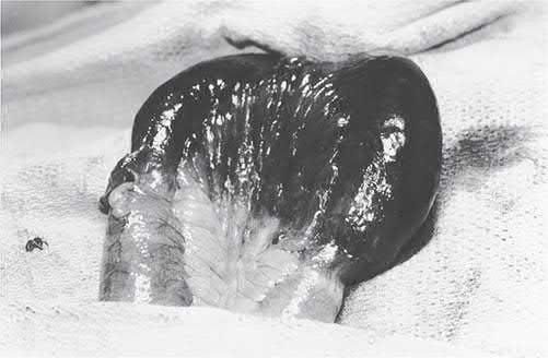 Gangrenous bowel from an irreversible, strangulated, incarcerated inguinal hernia