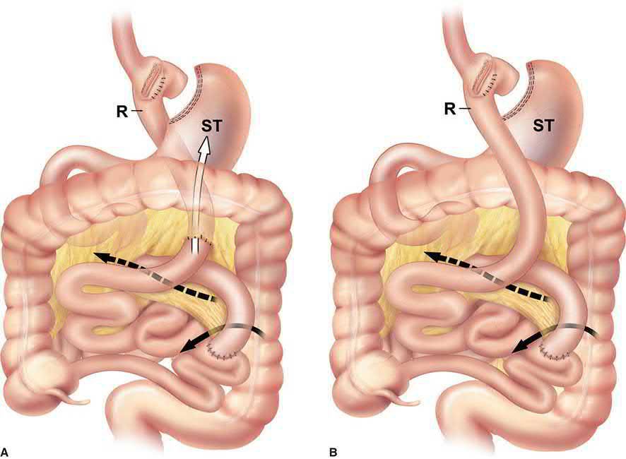 Internal hernia defects after Roux-en-Y gastric bypass: A, retrocolic; B, antecolic. Mesenteric defect at the enteroenterostomy, transverse mesocolic defect and Petersen's hernia